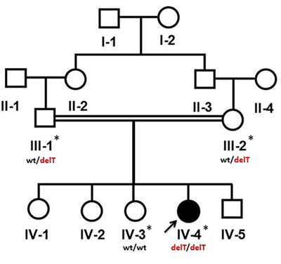 A Novel Homozygous Frameshift Mutation in CCN6 Causing Progressive Pseudorheumatoid Dysplasia (PPRD) in a Consanguineous Yemeni Family